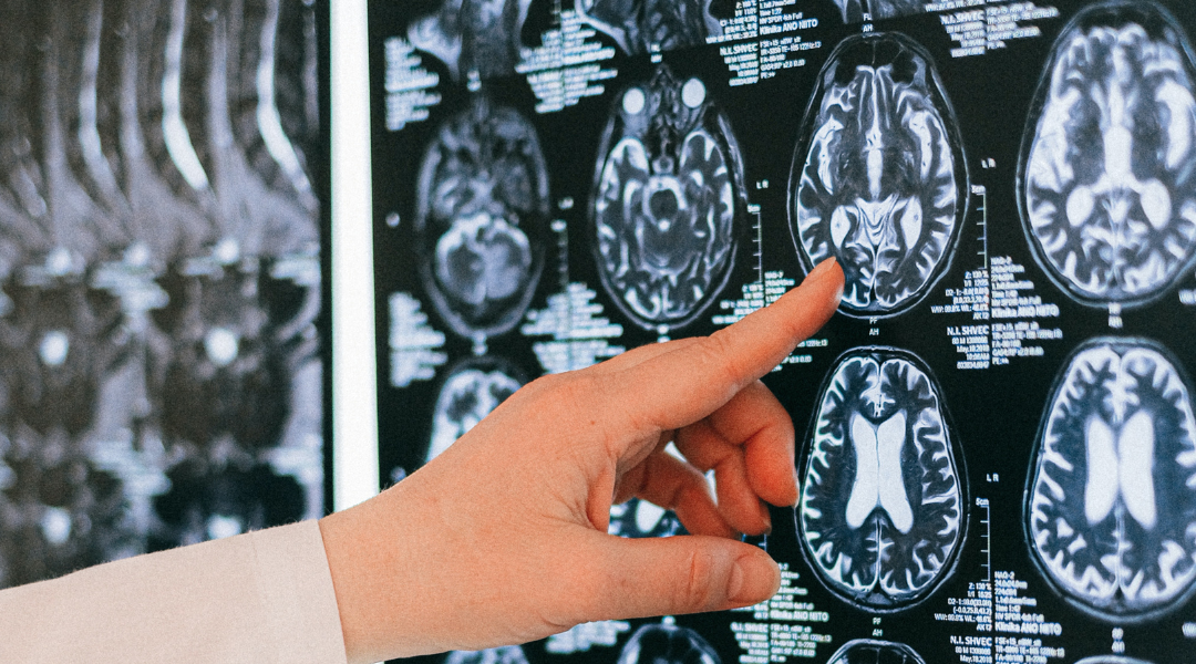 Can Ketones Help Deter the Effects of Alzheimer’s?